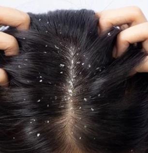 केसांतील डँड्रफ सतत खांद्यावर पडतो ? शाम्पू - तेल बदलूनही फरक नाही, करा व्हिनेगरचा सोपा उपाय...