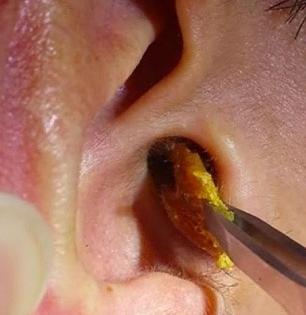 १० सेकंदात निघेल कानातला मळ; डॉक्टर सांगतात 3 उपाय, मळ निघेल-ऐकूही नीट येईल