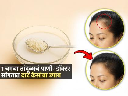 केसांचा झाडू झाला? चमचाभर तांदूळाचं पाणी 'असं केसांना लावा, डॉक्टर सांगतात दाट केसांचा उपाय - Marathi News | How To Apply Rice Water On Hairs : Rice Water For Hair Growth Advice by Doctor | Latest sakhi News at Lokmat.com केसांचा झाडू झाला? चमचाभर तांदूळाचं पाणी 'असं केसांना लावा, डॉक्टर सांगतात दाट केसांचा उपाय - Marathi News | How To Apply Rice Water On Hairs : Rice Water For Hair Growth Advice by Doctor | Latest sakhi News at Lokmat.com
