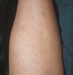 रेझरने पायावरचे केस काढल्याने स्ट्रॉबेरी लेग्ज दिसतात विचित्र, पाहा पायांवर खड्डे पाडणारा हा कोणता त्रास