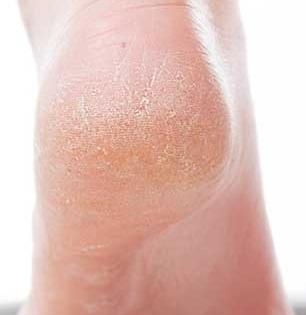 पायाला सारख्या भेगा पडतात? सामान्य वाटणारी समस्या ठरेल धोक्याची, पाहा सोपे घरगुती उपाय