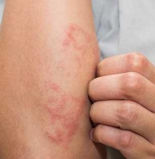 पित्त वाढून देतं त्रास? फक्त आहारात करा साधे बदल, एकही गोळी घ्यावी लागणार नाही