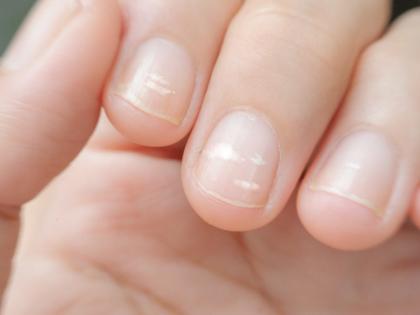 White spots on nails can be dangerous can be signs of leukonychia | तुमच्या नखांवर पांढरे डाग आहेत का? वेळीच व्हा सावध, अन्यथा पडेल महागात