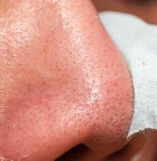 ब्लॅकहेड्समुळे नाक दिसते काळे? पार्लर नको घरीच करा सोपे उपाय, चेहरा दिसेल सुंदर