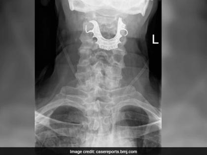 Dentures were stuck in a mans throat it was detected a week later | घशातून रक्त येतं म्हणून डॉक्टरकडे गेले आजोबा, एक्सरे पाहून डॉक्टरसोबत आजोबाही हैराण!