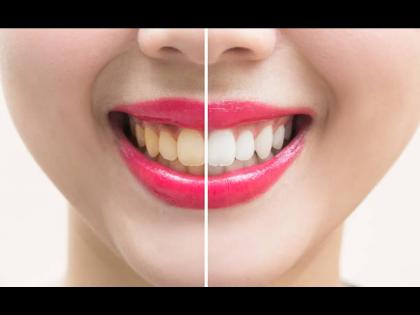 Ayurveda doctor told recipe of teeth whitening powder at home to make your yellow teeth white | डेंटिस्टला द्यावे लागणार नाही 2 हजार रूपये, या आयुर्वेदिक पावडरने घरीच दूर करा दातांचा पिवळेपणा