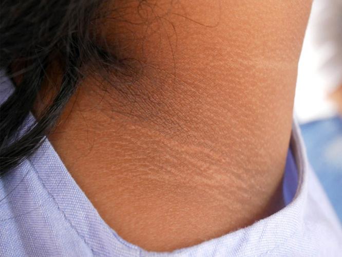 मळ साचून मुलांची मान, हाताचे कोपरे काळे पडले? १ सोपा उपाय- ५ मिनिटांत मान होईल स्वच्छ मळ साचून मुलांची मान, हाताचे कोपरे काळे पडले? १ सोपा उपाय- ५ मिनिटांत मान होईल स्वच्छ