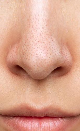 नाकावरचे ब्लॅकहेड्स, व्हाईटहेड्स ५ मिनिटांत हाेतील गायब, लगेच करा १ सोपा घरगुती उपाय