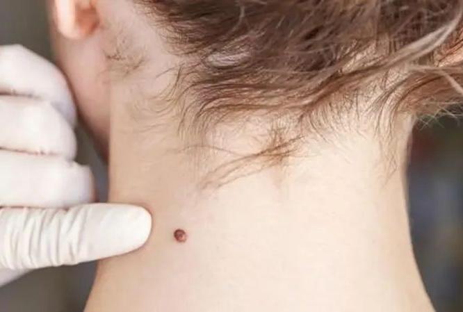 चेहरा-पाठीवरची चामखीळ कमी होणारा सोपा उपाय-नारळाच्या तेलात ५ गोष्टी मिसळून लावा चेहरा-पाठीवरची चामखीळ कमी होणारा सोपा उपाय-नारळाच्या तेलात ५ गोष्टी मिसळून लावा