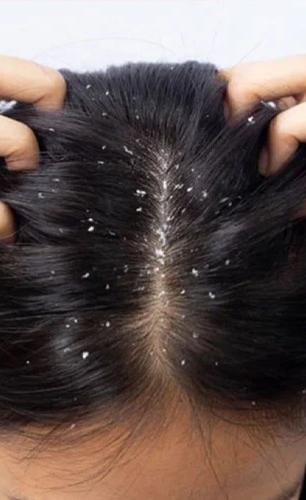 हिवाळा सुरू होताच केस गळणं वाढलं? 'हा' सोपा उपाय महिनाभर करा, केस गळणं बंद होईल