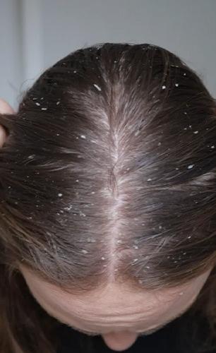 हिवाळ्यात डोक्यातला कोंडा खूपच वाढला? स्वयंपाक घरातले ४ पदार्थ लावा, काही दिवसांतच कोंडा गायब हिवाळ्यात डोक्यातला कोंडा खूपच वाढला? स्वयंपाक घरातले ४ पदार्थ लावा, काही दिवसांतच कोंडा गायब