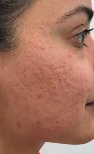 चेहऱ्यावर शिंपडा लवंगचं जादुई पाणी, हळूहळू त्वचेचं सौंदर्य खुलून चेहरा दिसेल फ्रेश, ग्लोईंग..