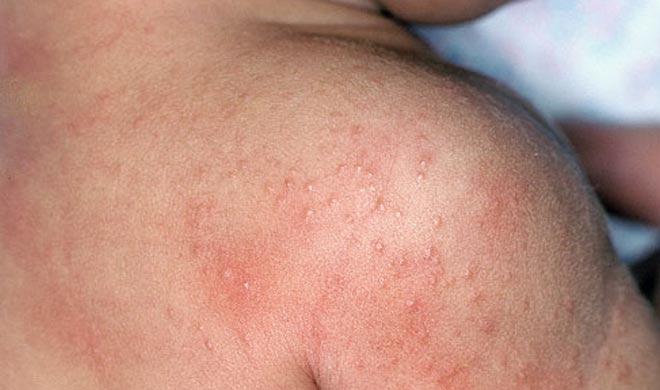 मुलांना खूप घामोळ्या झाल्या आहेत? ५ घरगुती उपाय, आग होणं थांबेल-घामोळ्याही होतील कमी मुलांना खूप घामोळ्या झाल्या आहेत? ५ घरगुती उपाय, आग होणं थांबेल-घामोळ्याही होतील कमी