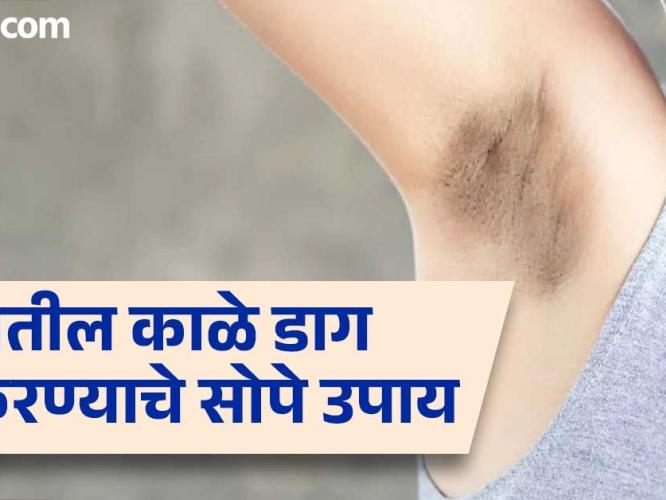 काखेत काळेपण-हाताचे कोपरे काळवंडले? १ चमचा मसूर डाळीचा ‘हा’ उपाय झटकन करतो टॅनिंग कमी काखेत काळेपण-हाताचे कोपरे काळवंडले? १ चमचा मसूर डाळीचा ‘हा’ उपाय झटकन करतो टॅनिंग कमी