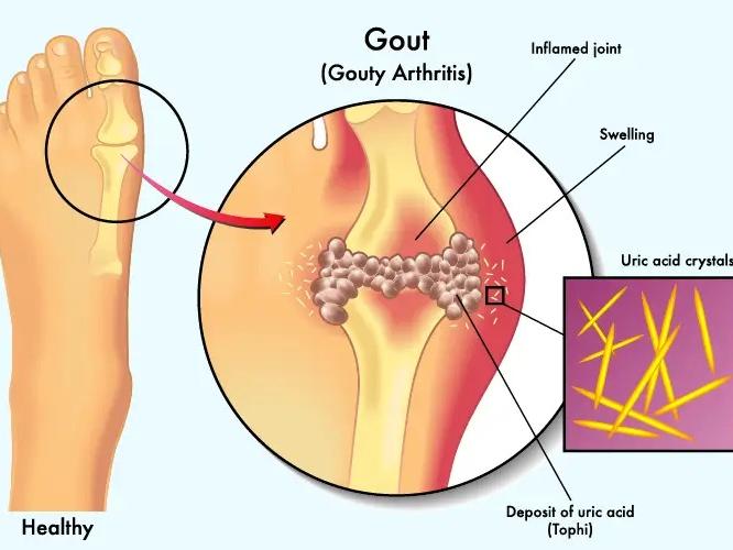 शरीरातलं घातक युरिक अॅसिड नियंत्रणात ठेवण्याचे ७ उपाय; हाडं-मसल्स राहतील मजबूत शरीरातलं घातक युरिक अॅसिड नियंत्रणात ठेवण्याचे ७ उपाय; हाडं-मसल्स राहतील मजबूत