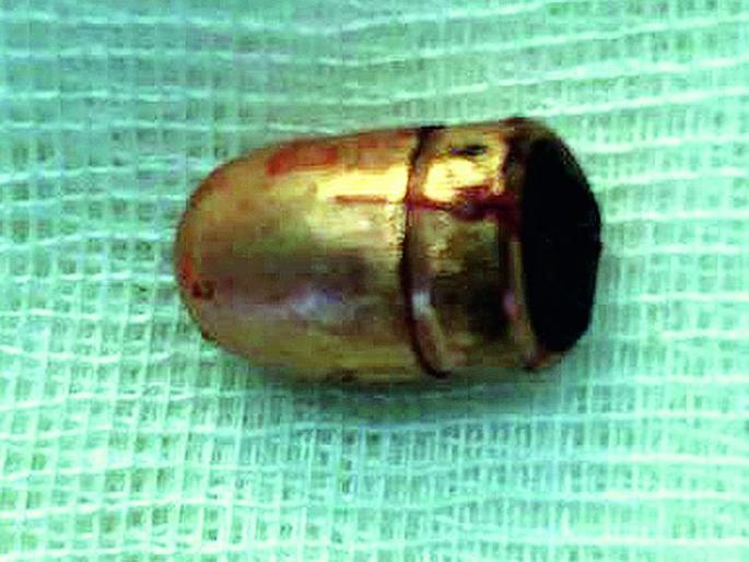 Bullet fixes in jaw removed successfully by Nagpur Govt.Dental Hospital | बापरे! डॉक्टरांनी जबड्यातून काढली बंदुकीची गोळी; नागपुरात यशस्वी शस्त्रक्रिया Bullet fixes in jaw removed successfully by Nagpur Govt.Dental Hospital | बापरे! डॉक्टरांनी जबड्यातून काढली बंदुकीची गोळी; नागपुरात यशस्वी शस्त्रक्रिया