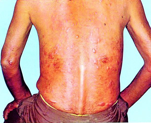 4 thousand 832 suspected lepers | ४ हजार ८३२ संशयित कुष्ठरोगी