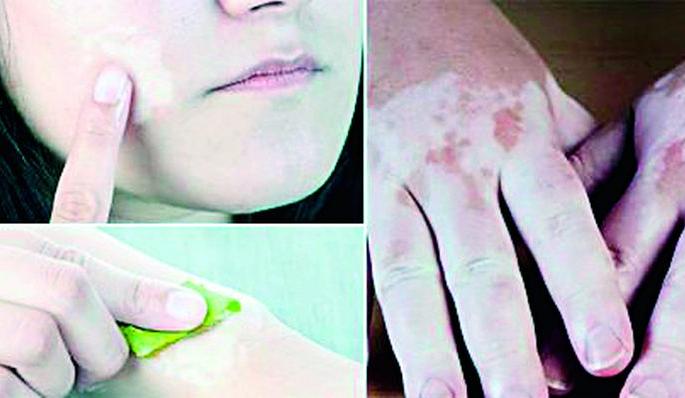 If there is code on the skin, where is the problem? | त्वचेवर कोड असेल तर बिघडले कोठे?