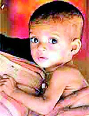 Malnutrition increased in the district | जिल्ह्यात वाढले कुपोषण Malnutrition increased in the district | जिल्ह्यात वाढले कुपोषण