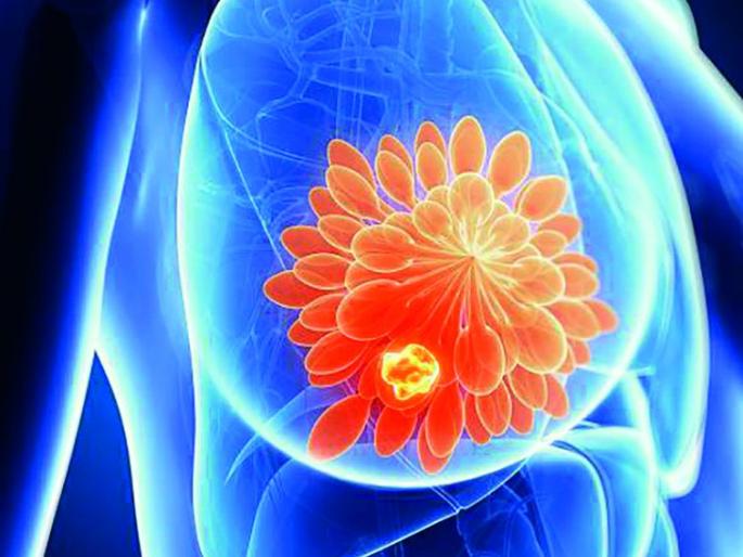 Breast Cancer Awareness Month; How Will Be An Effective Treatment? | स्तन कर्करोग जनजागृती महिना; कसा होईल प्रभावी उपचार? Breast Cancer Awareness Month; How Will Be An Effective Treatment? | स्तन कर्करोग जनजागृती महिना; कसा होईल प्रभावी उपचार?