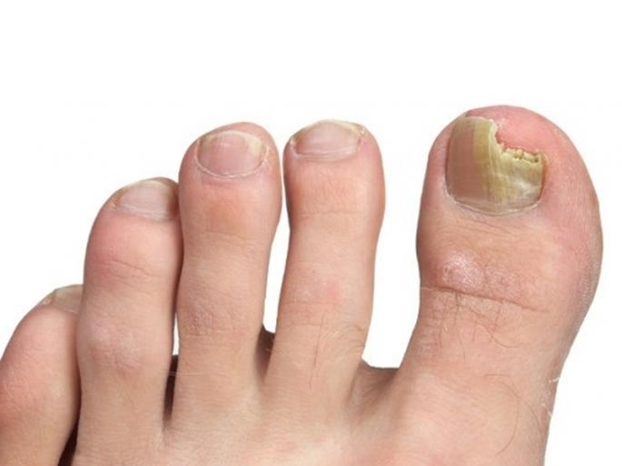 What to do if the fingernails are infected with fungus? | नखांना बुरशीचा संसर्ग झाल्यास काय कराल? What to do if the fingernails are infected with fungus? | नखांना बुरशीचा संसर्ग झाल्यास काय कराल?