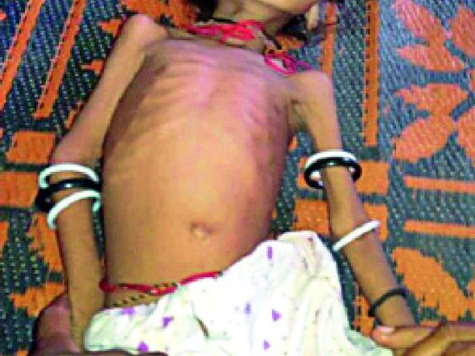 30 9 7 child malnourished | ३०९७ बालके कुपोषित 30 9 7 child malnourished | ३०९७ बालके कुपोषित
