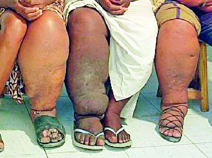 Seven thousand people suffer from heart disease in the district | जिल्ह्यात सात हजार नागरिक हत्तीरोगाने पीडित Seven thousand people suffer from heart disease in the district | जिल्ह्यात सात हजार नागरिक हत्तीरोगाने पीडित