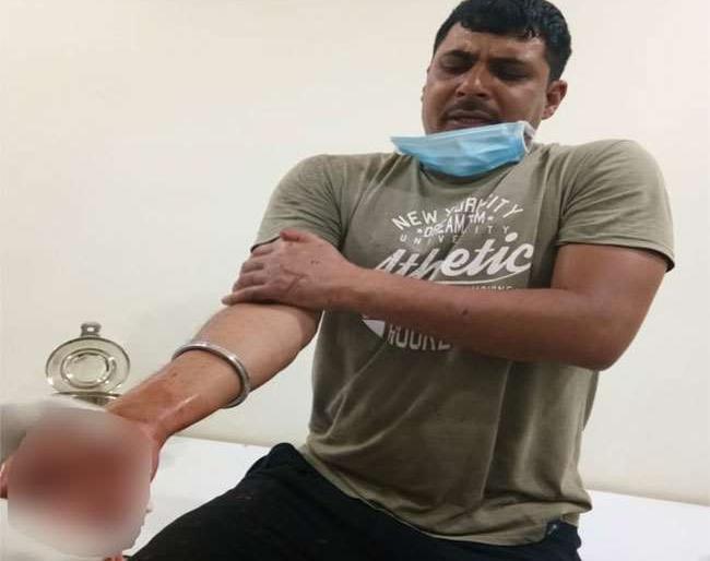 Coronavirus Lockdown : During the lockdown, the soldier's hand's fingers was cut off pda | Coronavirus Lockdown : खेदजनक! लॉकडाऊनदरम्यान पहारा देणाऱ्या जवानाच्या हाताची बोटं कापली Coronavirus Lockdown : During the lockdown, the soldier's hand's fingers was cut off pda | Coronavirus Lockdown : खेदजनक! लॉकडाऊनदरम्यान पहारा देणाऱ्या जवानाच्या हाताची बोटं कापली