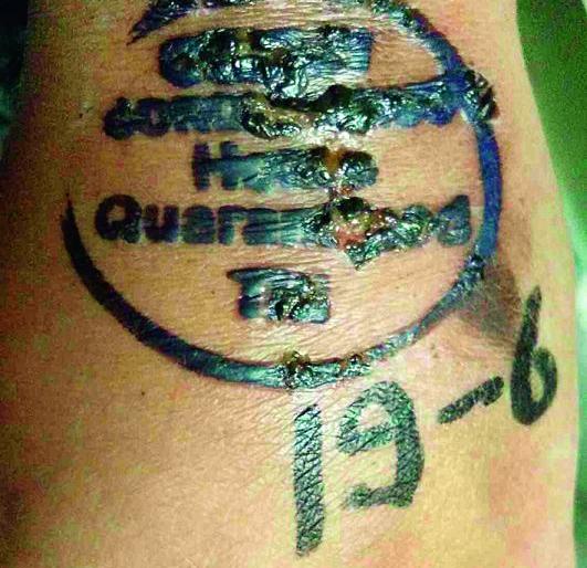 Hand injuries due to quarantine stamp; | क्वारंटाईन स्टॅम्पमुळे हातावर जखम; पुण्याहून नागपुरात आलेल्या दाम्पत्याला घ्यावा लागला उपचार Hand injuries due to quarantine stamp; | क्वारंटाईन स्टॅम्पमुळे हातावर जखम; पुण्याहून नागपुरात आलेल्या दाम्पत्याला घ्यावा लागला उपचार