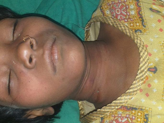 Attempt to hang a girl in the forest of Dehrewadi | देहरेवाडीच्या जंगलात मुलीला फासावर लटकविण्याचा प्रयत्न Attempt to hang a girl in the forest of Dehrewadi | देहरेवाडीच्या जंगलात मुलीला फासावर लटकविण्याचा प्रयत्न