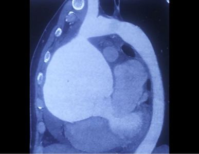 A tumor removed from the heart after 8 hours of surgery | ८ तासाच्या शस्त्रक्रियेनंतर हृदयातून काढली गाठ A tumor removed from the heart after 8 hours of surgery | ८ तासाच्या शस्त्रक्रियेनंतर हृदयातून काढली गाठ