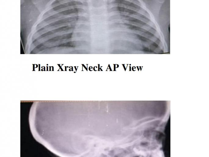 A coin in Chimukalya's esophagus, a piece of coconut in his lungs | चिमुकल्याच्या अन्ननलिकेतील नाणे, फुप्फुसातील खोबऱ्याचा तुकडा काढला A coin in Chimukalya's esophagus, a piece of coconut in his lungs | चिमुकल्याच्या अन्ननलिकेतील नाणे, फुप्फुसातील खोबऱ्याचा तुकडा काढला