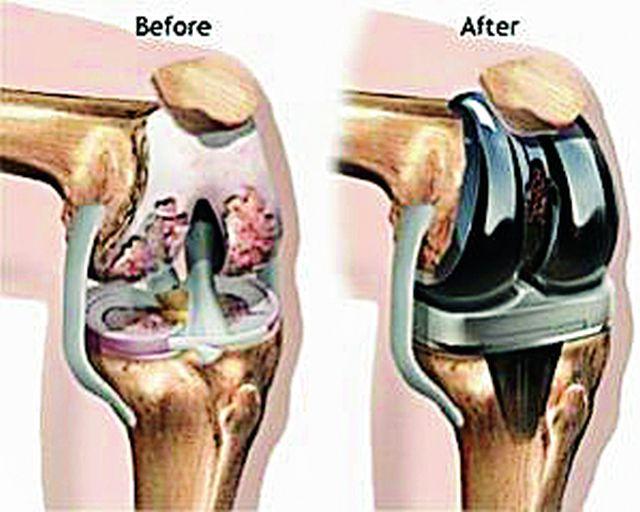 Sacral Knee Implant Surgery | साकोलीत गुडघा प्रत्यारोपण शस्त्रक्रिया Sacral Knee Implant Surgery | साकोलीत गुडघा प्रत्यारोपण शस्त्रक्रिया