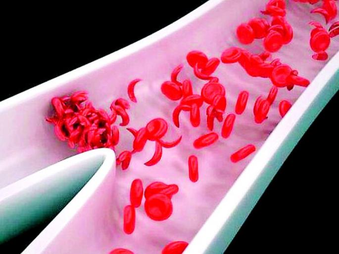 34 thousand 805 sickle cell patients | सिकलसेलचे 34 हजार 805 रुग्ण 34 thousand 805 sickle cell patients | सिकलसेलचे 34 हजार 805 रुग्ण