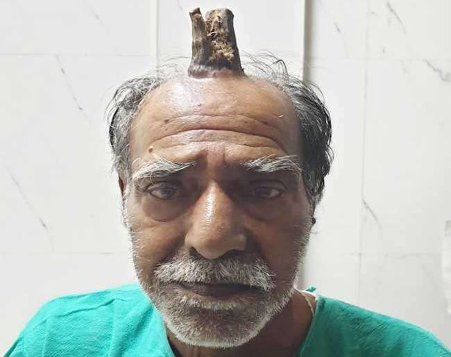 Shocking...! horn grown on head of 74 year old man in madhya pradesh | डोके आदळू नका, शिंग उगवेल....अरेच्चा खरेच उगवले की! Shocking...! horn grown on head of 74 year old man in madhya pradesh | डोके आदळू नका, शिंग उगवेल....अरेच्चा खरेच उगवले की!