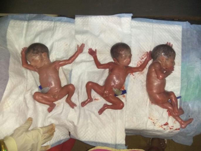 Tribes were given to women in an anesthetist | रूग्णवाहिकेतच महिलेने दिला तिळ्यांना जन्म Tribes were given to women in an anesthetist | रूग्णवाहिकेतच महिलेने दिला तिळ्यांना जन्म