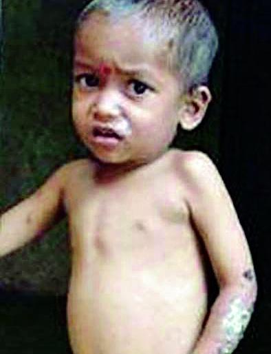 628 malnourished children | ६२८ बालके कुपोषित 628 malnourished children | ६२८ बालके कुपोषित