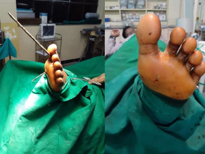 Successfully removed iron rod inserted into the foot; Incidents in Wardha district | पायात घुसलेली लोखंडी सळई यशस्वीरित्या काढली; वर्धा जिल्ह्यातील घटना