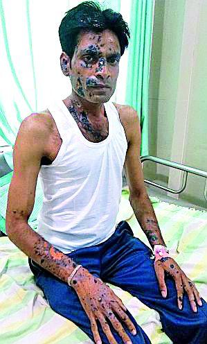 The young man in the tanker jumped from the tanker | टँकरमधील डांबर उसळून भाजला युवक The young man in the tanker jumped from the tanker | टँकरमधील डांबर उसळून भाजला युवक