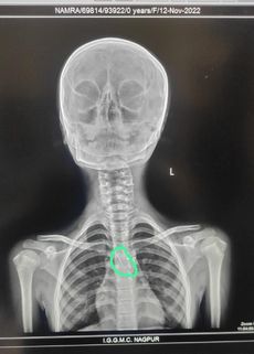 Sixth grade girl swallows pointed pin attached to hijab | सहावीतल्या मुलीने गिळली हिजाबला लावलेली टोकदार पीन Sixth grade girl swallows pointed pin attached to hijab | सहावीतल्या मुलीने गिळली हिजाबला लावलेली टोकदार पीन