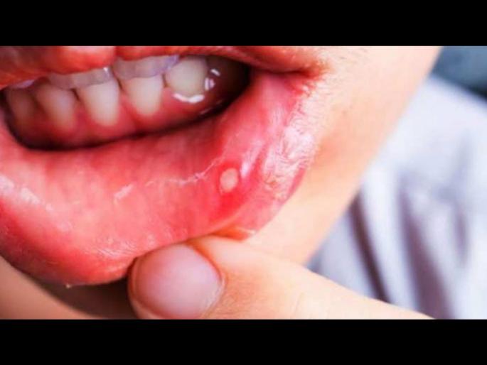 Mouth ulcer home remedies what to do in mouth ulcers | तोंडाला पुन्हा पुन्हा फोड येत असल्याने हैराण आहात? एकदा करून बघाच हे घरगुती उपाय Mouth ulcer home remedies what to do in mouth ulcers | तोंडाला पुन्हा पुन्हा फोड येत असल्याने हैराण आहात? एकदा करून बघाच हे घरगुती उपाय