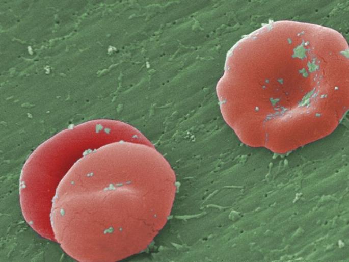 Not even using billions of sq. Cellular eradication | कोट्यवधी खर्चूनही सिकलसेल निर्मूलन नाही Not even using billions of sq. Cellular eradication | कोट्यवधी खर्चूनही सिकलसेल निर्मूलन नाही