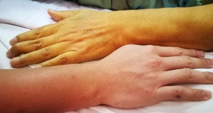 World Jaundice Day; Danger of death if diagnosed late! | जागतिक कावीळ दिन; निदानात उशीर झाल्यास मृत्यूचा धोका! World Jaundice Day; Danger of death if diagnosed late! | जागतिक कावीळ दिन; निदानात उशीर झाल्यास मृत्यूचा धोका!