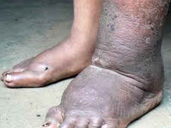 Nandurbar district will be 'elephant free' by 2024 | 2024 र्पयत नंदुरबार जिल्हा होणार ‘हत्तीरोग’ मुक्त Nandurbar district will be 'elephant free' by 2024 | 2024 र्पयत नंदुरबार जिल्हा होणार ‘हत्तीरोग’ मुक्त