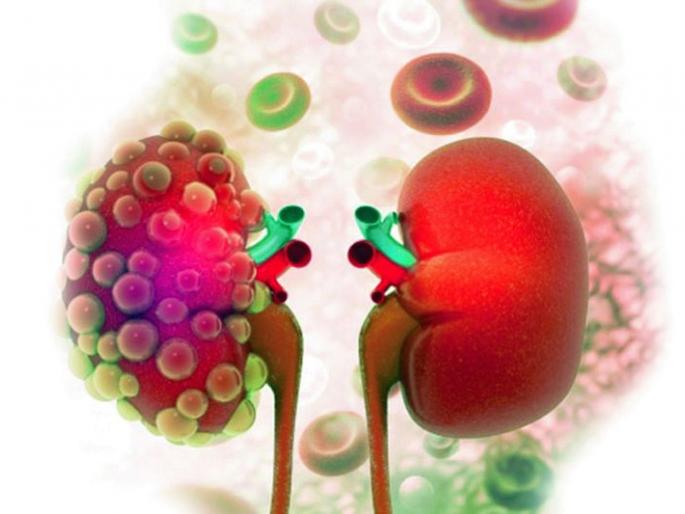 Kidney damage due to corona virus; Pay attention to the symptoms! | कोरोना विषाणूमुळे किडनीचे नुकसान; लक्षणांकडे लक्ष द्या! Kidney damage due to corona virus; Pay attention to the symptoms! | कोरोना विषाणूमुळे किडनीचे नुकसान; लक्षणांकडे लक्ष द्या!