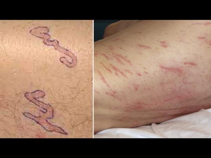 Terrible disease strange marks are being made at such places of the body difficult to treat | एका अजब आजारामुळे डॉक्टरही झाले हैराण, उपचार करणंही होत आहे अवघड Terrible disease strange marks are being made at such places of the body difficult to treat | एका अजब आजारामुळे डॉक्टरही झाले हैराण, उपचार करणंही होत आहे अवघड