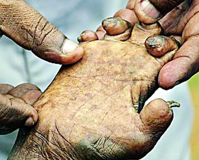 301 new leprosy detected in search operation | शोधमोहिमेत आढळले ३०१ नवीन कुष्ठरुग्ण