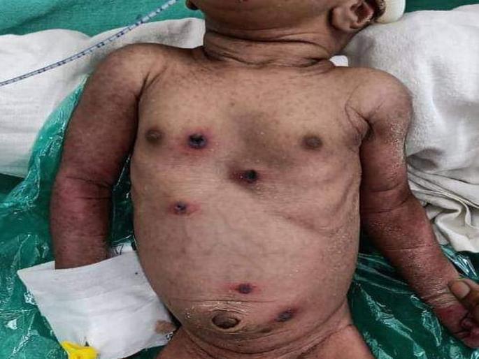 The climax of agony! A five-day-old baby was given a bottle of milk | अघोरीपणाचा कळस! पाच दिवसांच्या चिमुकलीला दिले बिब्याचे चटके The climax of agony! A five-day-old baby was given a bottle of milk | अघोरीपणाचा कळस! पाच दिवसांच्या चिमुकलीला दिले बिब्याचे चटके