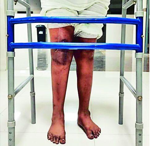 After two and a half years, she got up from bed and started walking! Success to AIIMS efforts | अडीच वर्षांनंतर 'ती' बेडवरून उठून चालायला लागली! ‘एम्स’च्या प्रयत्नांना यश After two and a half years, she got up from bed and started walking! Success to AIIMS efforts | अडीच वर्षांनंतर 'ती' बेडवरून उठून चालायला लागली! ‘एम्स’च्या प्रयत्नांना यश