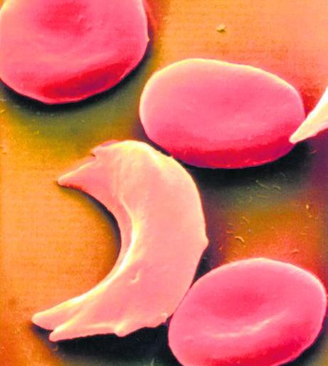 44 thousand children suffering from sickle cell in India | देशात ४४ हजार मुले सिकलसेलग्रस्त